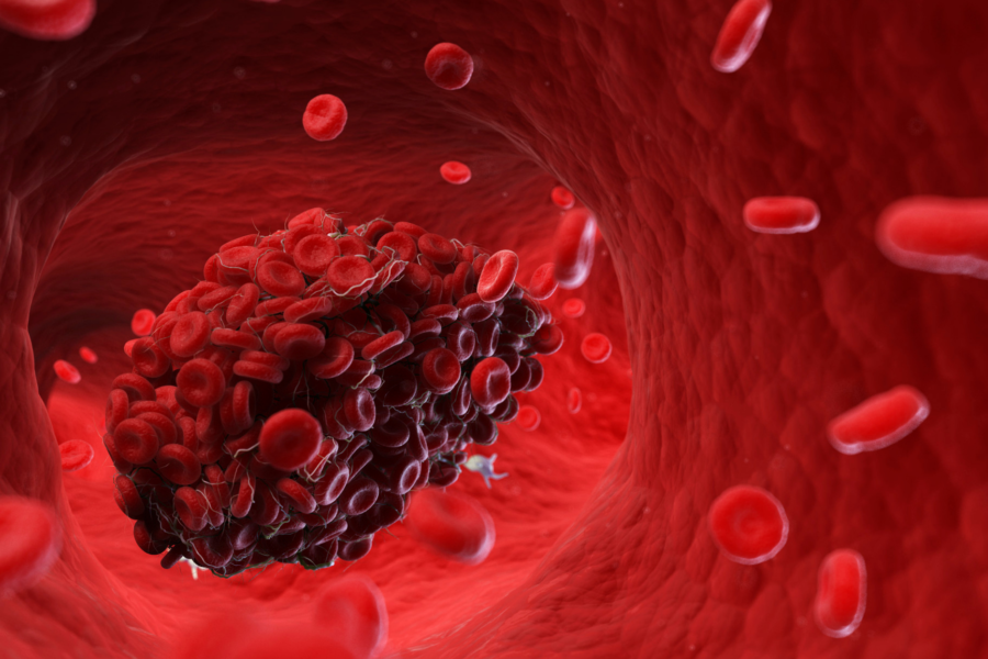 Preventing Blood Clots